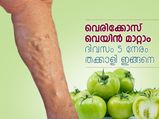 വെരിക്കോസ് വെയിന്‍ മാറ്റാം; 5 നേരം തക്കാളി ഇങ്ങനെ
