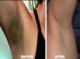 How To Use Potato Mix For Underarms Skin Whitening