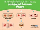 ഈ 5 തരത്തിലുള്ള മറുക് കണ്ടാല്‍ അല്‍പം ഭയക്കണം