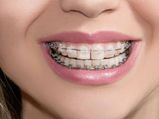 What Is A Good Age For The Child To Get Braces In Malayalam