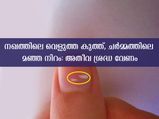 ശരീരത്തിലെ ഈ മാറ്റങ്ങള്‍ ശ്രദ്ധിക്കണം: ചര്‍മ്മത്തിലെ നിറം മാറ്റം പോലും അപകടം