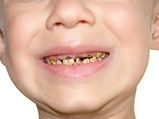 The Worst Foods For Your Kid S Teeth In Malayalam