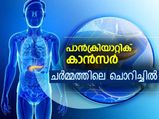 ഉറക്കം നഷ്ടപ്പെടുത്തുന്ന ചൊറിച്ചില്‍ :പാന്‍ക്രിയാറ്റിക് ക്യാന്‍സര്‍ലക്ഷണമോ?