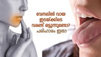 വേനലില്‍ വായ ഇടയ്ക്കിടെ വരണ്ട് ഒട്ടുന്നുണ്ടോ? പരിഹാരമുണ്ട് ഈ വഴികളില്‍