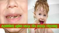 കുട്ടികളുടെ പല്ലിലെ നിറ വ്യത്യാസം ശ്രദ്ധിക്കണം: നിസ്സാരമാക്കല്ലേ