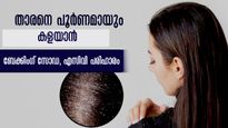 താരന്‍ വേരോടെ തുരത്തും ആപ്പിള്‍ സിഡാര്‍ വിനീഗറും ബേക്കിംഗ് സോഡയും