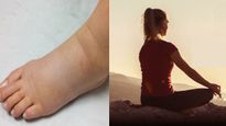 ഗര്‍ഭിണികളിലെ കാലിലെ നീരിനെ പെട്ടെന്ന് കുറക്കും യോഗയും വ്യായാമവും