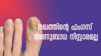 മഴക്കാലം തള്ളവിരലിലെ പഴുപ്പും പൂപ്പലും നിസ്സാരമല്ല: കിടപ്പിലാവാന്‍ അത് മതി
