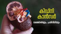 നടുവേദന, ഇടവിട്ടുള്ള പനി; ഈ ലക്ഷണങ്ങളെ അവഗണിക്കല്ലേ.. കിഡ്‌നി കാന്‍സര്‍ അപകടം