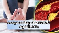 ചെറുപ്പക്കാര്‍ ഏറ്റവും കൂടുതല്‍ അവഗണിക്കുന്ന ലക്ഷണങ്ങള്‍: കൊളസ്‌ട്രോള്‍ നിസ്സാരലക്ഷണങ്ങള്‍ ശ്രദ്ധിക്കണം