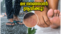 മഴ നനഞ്ഞാൽ പണി പാളും! ചർമ്മത്തെയും പാദങ്ങളെയും അണുബാധയിൽ നിന്ന് രക്ഷിക്കാൻ ഈ മുൻകരുതലുകൾ മതി