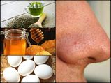 Simple Remedies Remove Blackheads