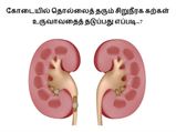 கோடையில் தொல்லைத் தரும் சிறுநீரக கற்கள் உருவாவதைத் தடுப்பது எப்படி...?