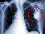 Things You Should Know About Pacemakers