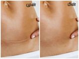 Natural Ways To Get Rid Of Caesarean Scars