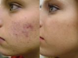 Top Ways To Remove Acne Scars Fast In 7 Days