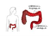 உங்களது பெருங்குடல் மோசமாக பாதிக்கப்பட்டுள்ளது என்பதை வெளிப்படுத்தும் அறிகுறிகள்!!!