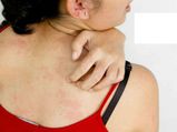 Seven Home Remedies To Treat Prickly Heat Or Heat Rash