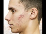Skin Care For Men Easy Tips To Get Rid Of Pimples