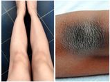 Home Remedies To Whiten Your Dark Knees