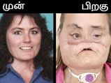 The Love Story First U S Face Transplant Recipient