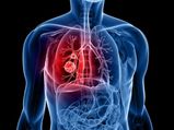 Causes Effects Lung Infection Copd