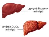 உங்கள் கல்லீரல் மோசமாக உள்ளது என்பதை வெளிக்காட்டும் சில அறிகுறிகள்!