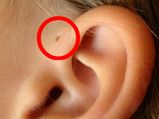 Do You Have Tiny Extra Hole Near Your Ear