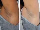 Expert Tips To Get Rid Of Dark Underarms