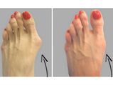 உங்கள் கால் பெருவிரலுக்கு கீழே வீக்கம் உள்ளதா? இதைப் போக்க இதோ ஓர் அற்புத வழி!