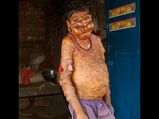 The Tragic Story A Boy Who Suffers From Tumours On His Face Body