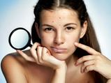 Acne Tells You About Inner Body