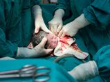 Side Effects Cesarean Delivery