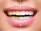 Activated Charcoal Capsules Teeth Whitening