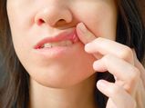 How To Cure Mouth Ulcers Fast Naturally