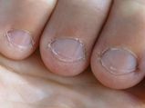 This Man Nearly Died Of Sepsis Caused By Biting His Nails