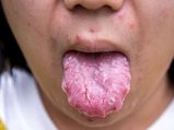 Home Remedies For Blisters On Tongue
