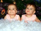 Monochorionic Monoamniotic Twins Momo Twins Mono Mono Twins