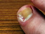 How To Get Rid Of Tornail Fungus Fast Naturally At Home