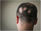 How To Fight Alopecia With Natural Solutions