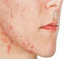 Rosacea Types Symptoms Causes And Home Remedies