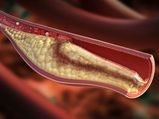 Everything You Need To Know About The Hypercholesterolemia Condition