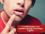 24 மணிநேரத்தில் வாய் புண்ணில் இருந்து விடுபட வேண்டுமா? இதோ சில வழிகள்!