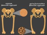 உங்கள் எலும்புகள் மென்மையாகி விட்டதா? அப்போ அது இந்த நோயா தான் இருக்கும்...