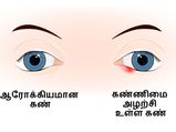 கண்ணிமை அழற்சி அல்லது வீக்கம் ஏற்படுவதற்கான முக்கியமான 5 காரணங்கள்!
