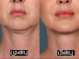 What Causes Neck Wrinkles And How To Get Rid Of Them