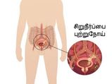 சிறுநீர்ப்பை புற்றுநோயின் அபாயம் யாருக்கு அதிகமாக உள்ளது? அறிகுறிகள் என்ன? அதைத் தடுப்பது எப்படி?