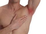 Home Remedies For Armpit Rash