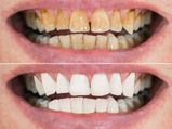 How To Remove Yellow Stains From Teeth Easily