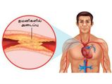 இரத்தக்குழாயில் அடைப்பு ஏற்படக்கூடாதா? அப்ப இந்த உணவுகளை அதிகம் சாப்பிடுங்க...